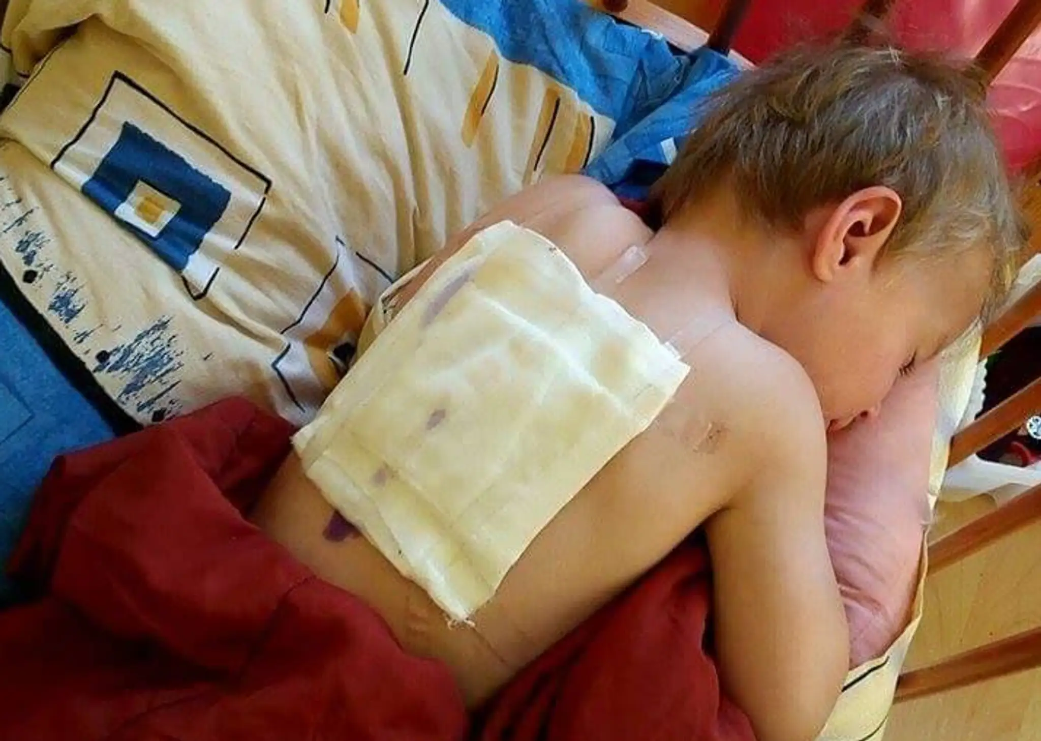 Dieťa má na chrbte odreniny a popáleniny
