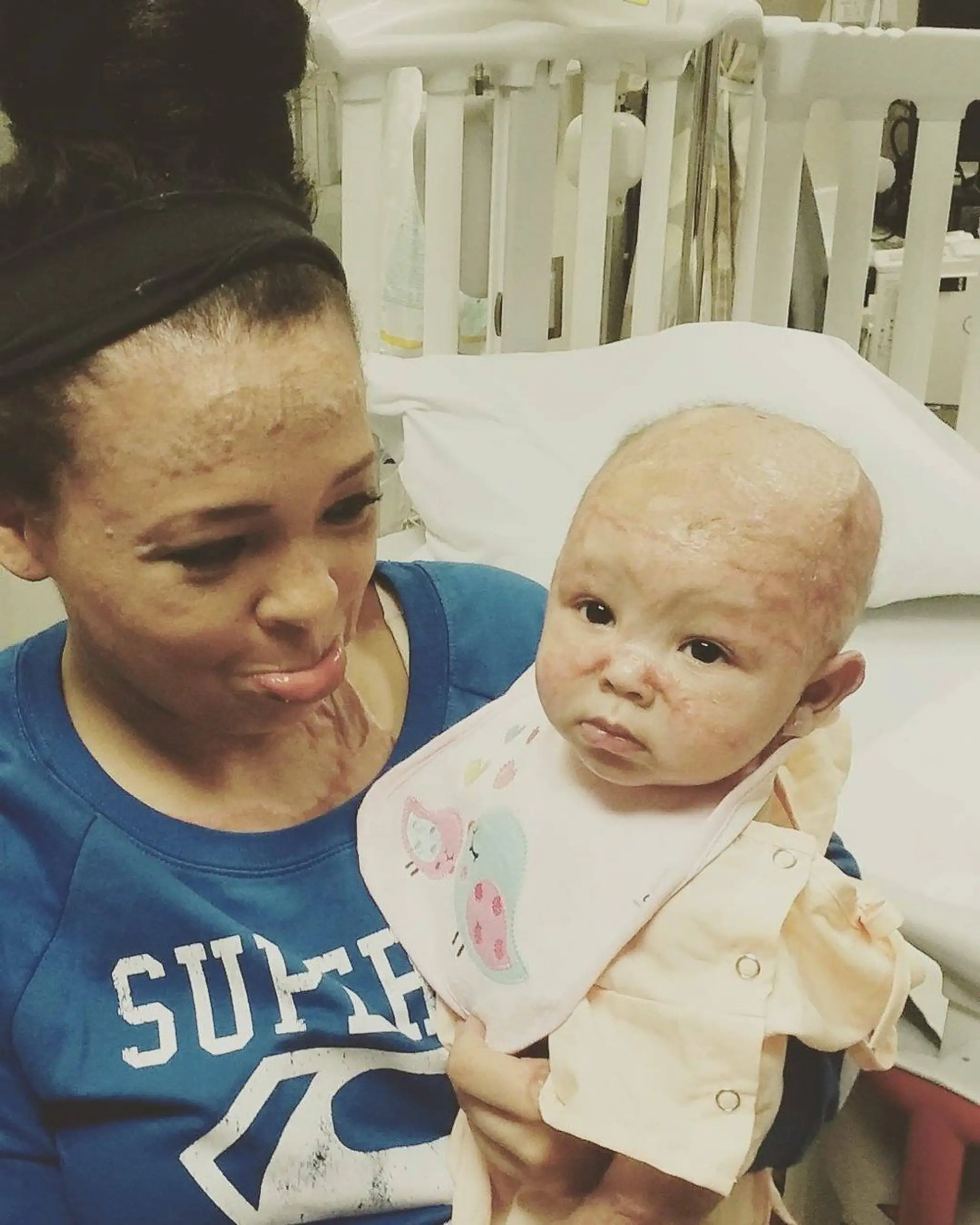 Whitney s dcérkou Nylou utrpeli popáleniny. 