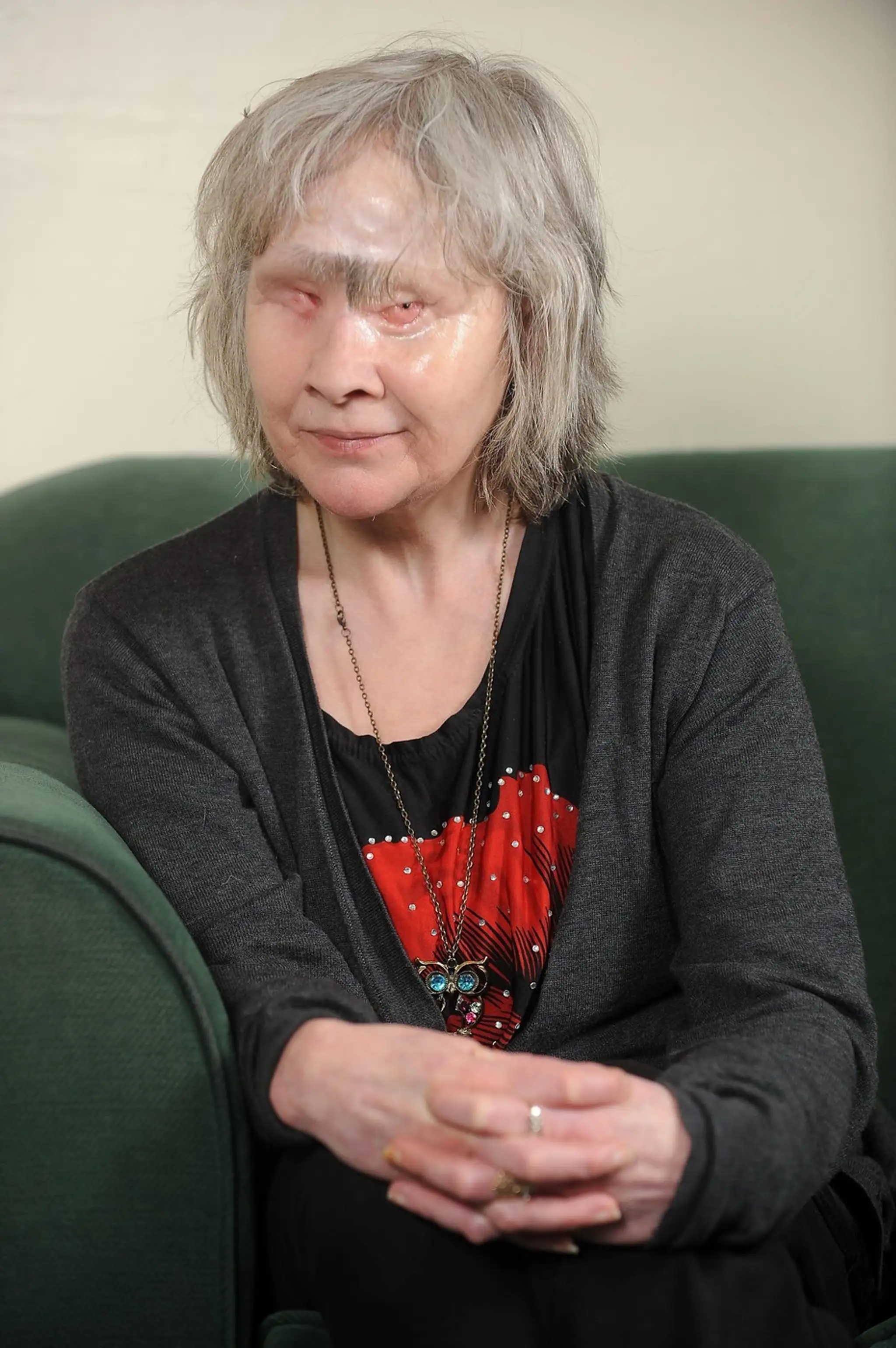 Wendy Hamridingovej zjedol pes tvár