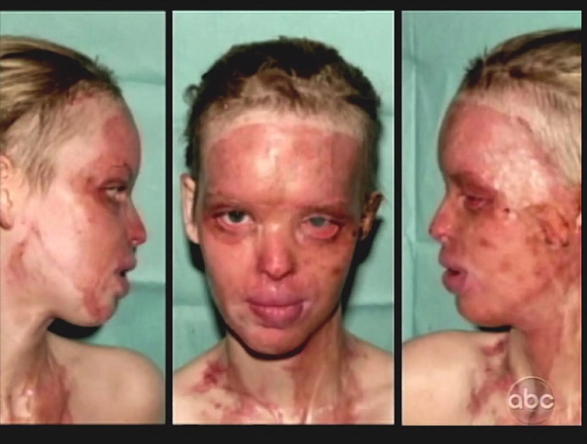 Katie Piper po útoku kyselinou.