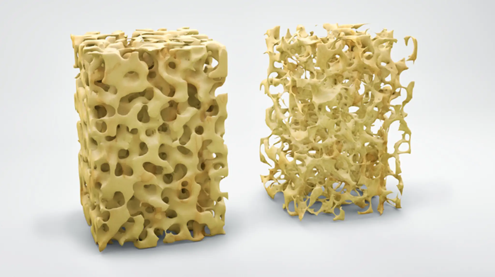Na 3D modeli vľavo štrúktúra normálnej kosti, vpravo kosť postinutá osteoporózou.