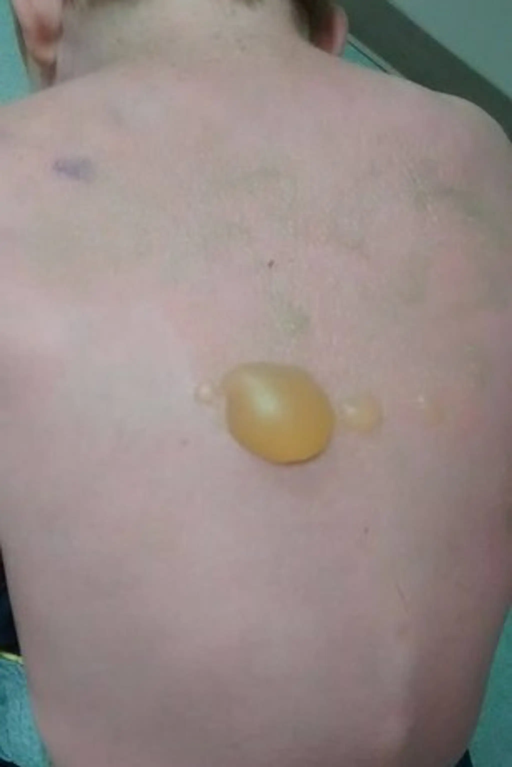 Chlapci utrpeli popáleniny druhého a tretieho stupňa.