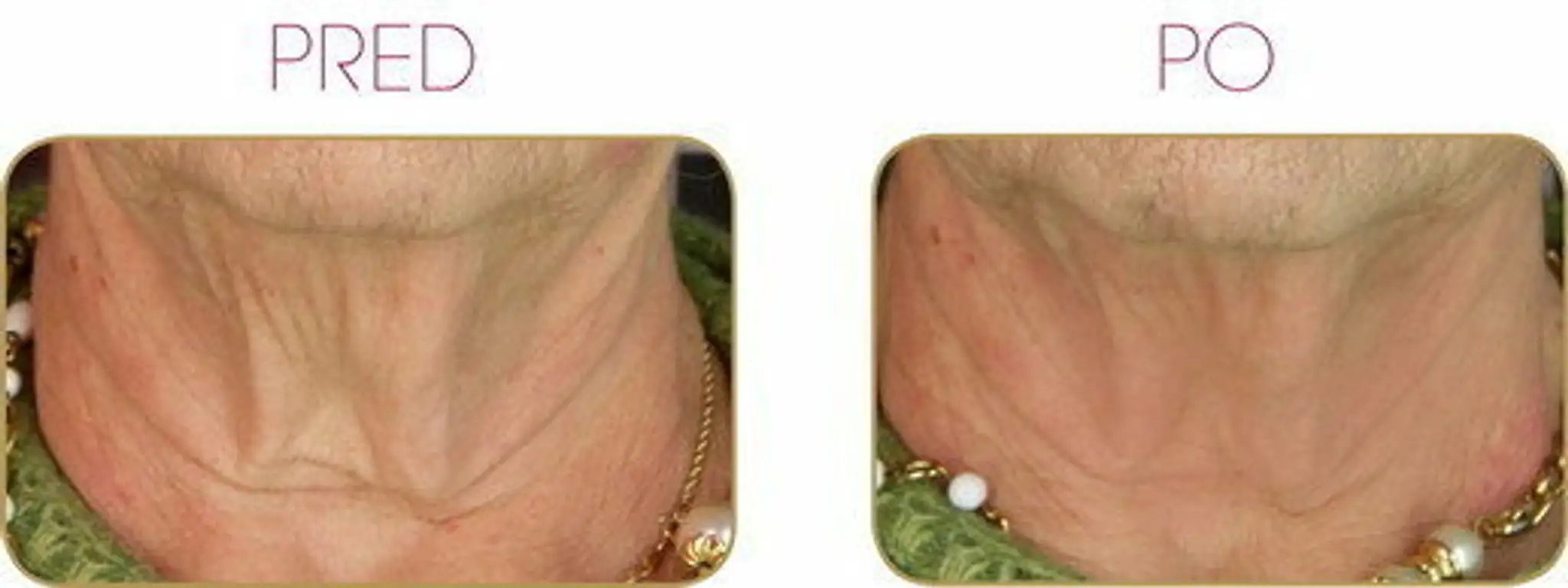 3_Poradňa -  Vampire facial.jpg