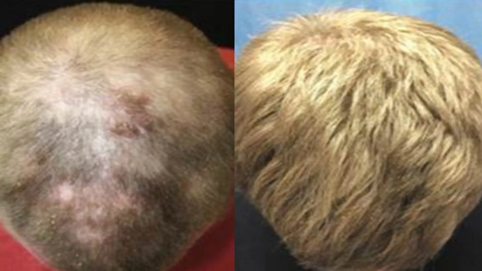 Alopecia areata