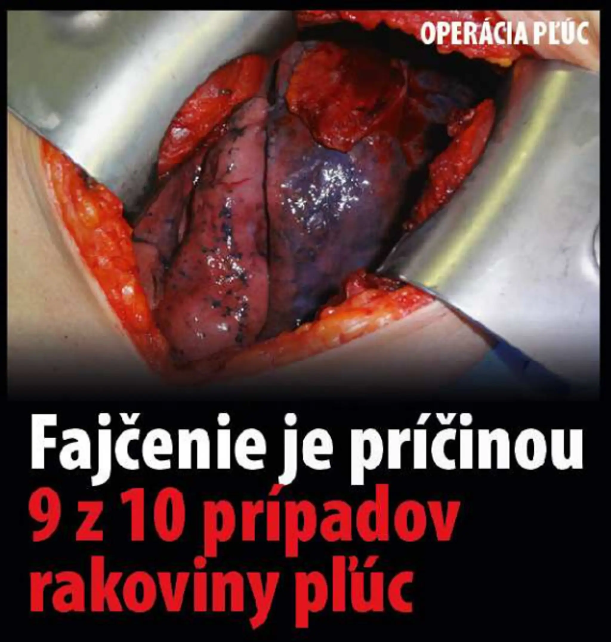Varovanie, čo všetko môže spôsobiť fajčenie