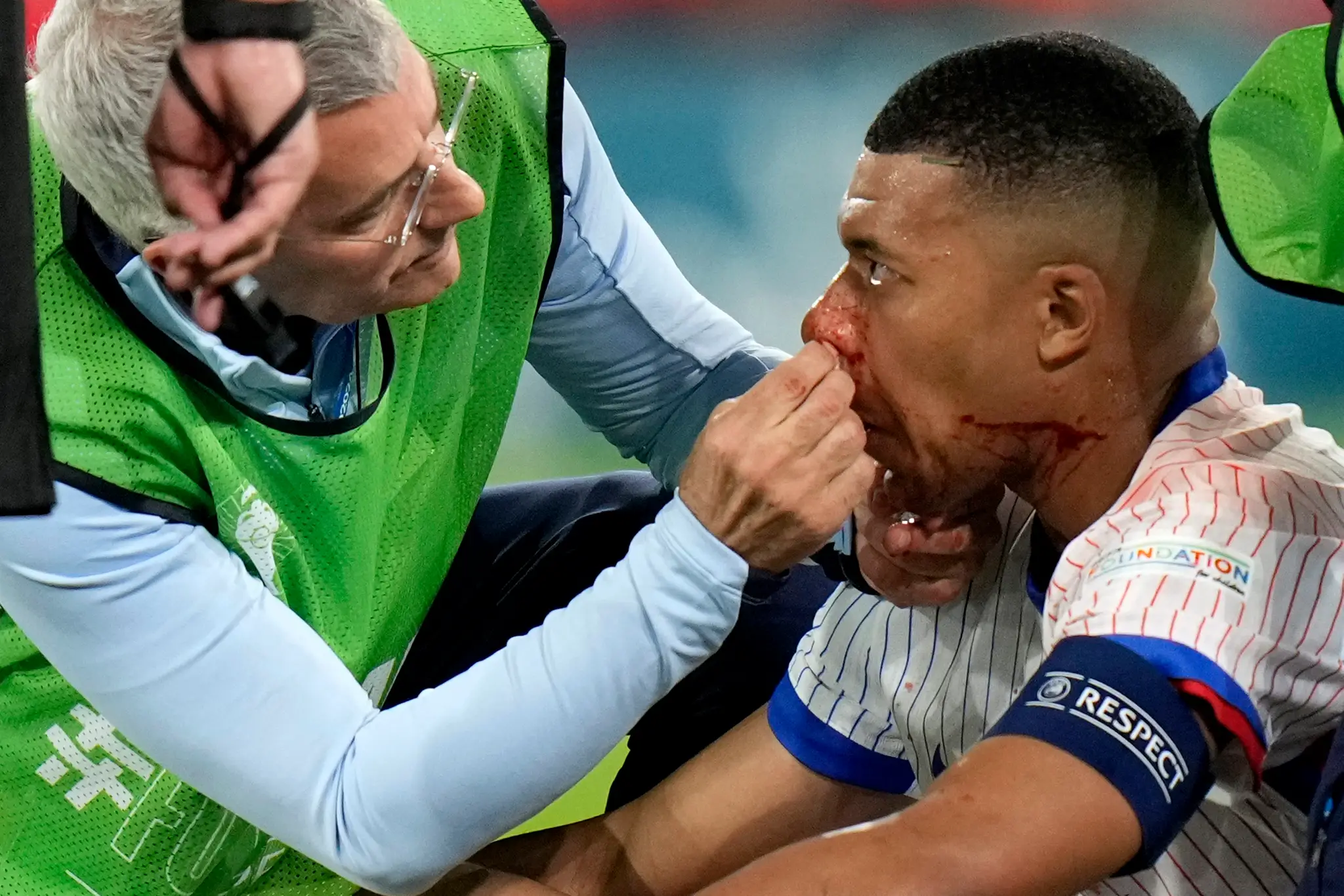 Kylian Mbappé si v zápase s Rakúskom zlomil nos
