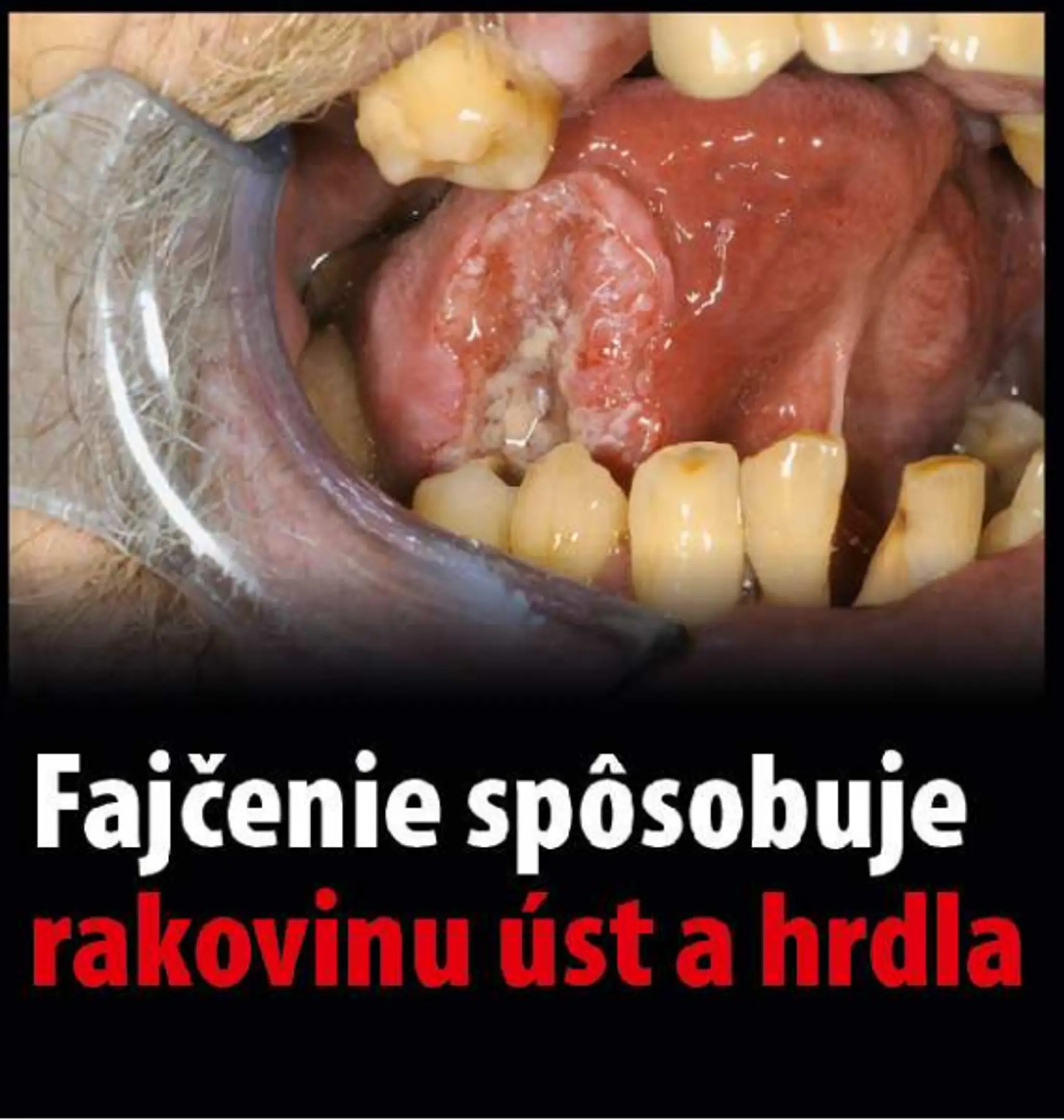 Varovanie, čo všetko môže spôsobiť fajčenie