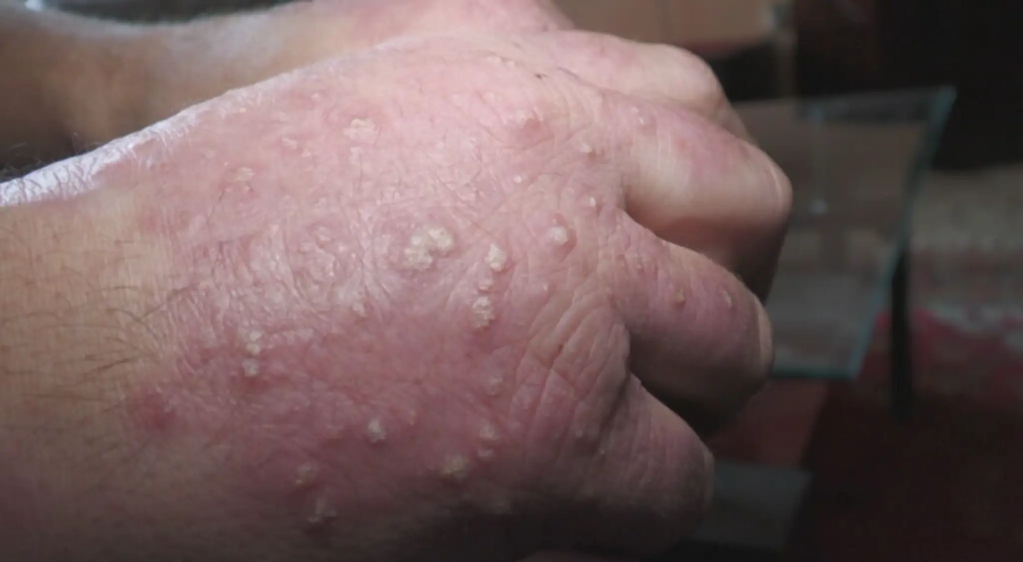 Psoriáza.