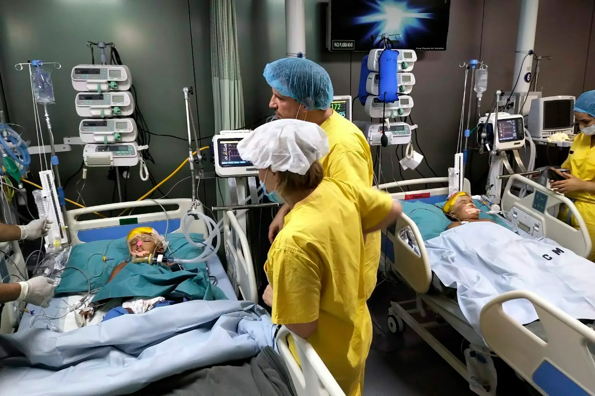 Obe zo siamských dvojčiat z Bangladéša sú už v stabilizovanom stave.