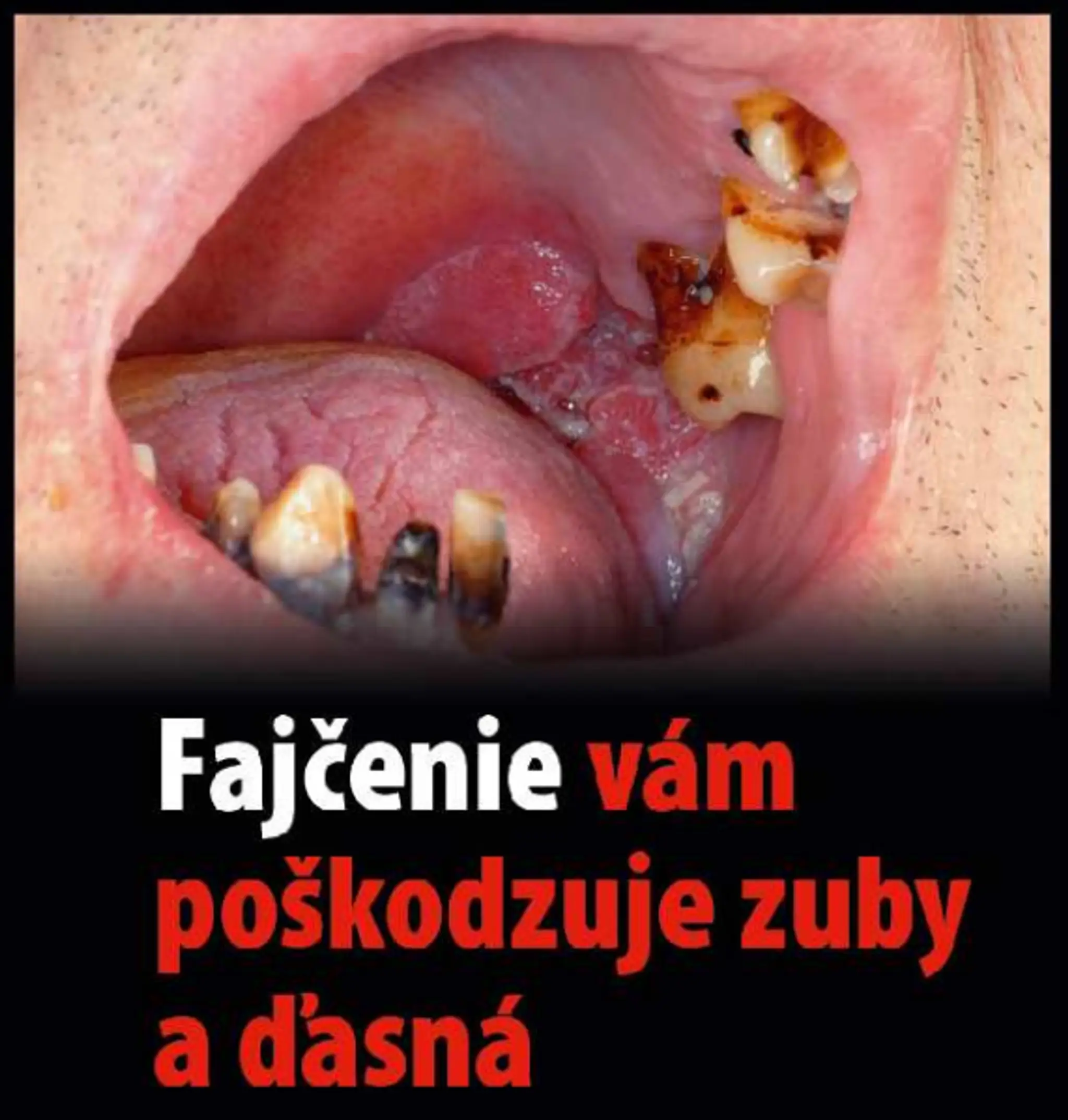 Varovanie, čo všetko môže spôsobiť fajčenie