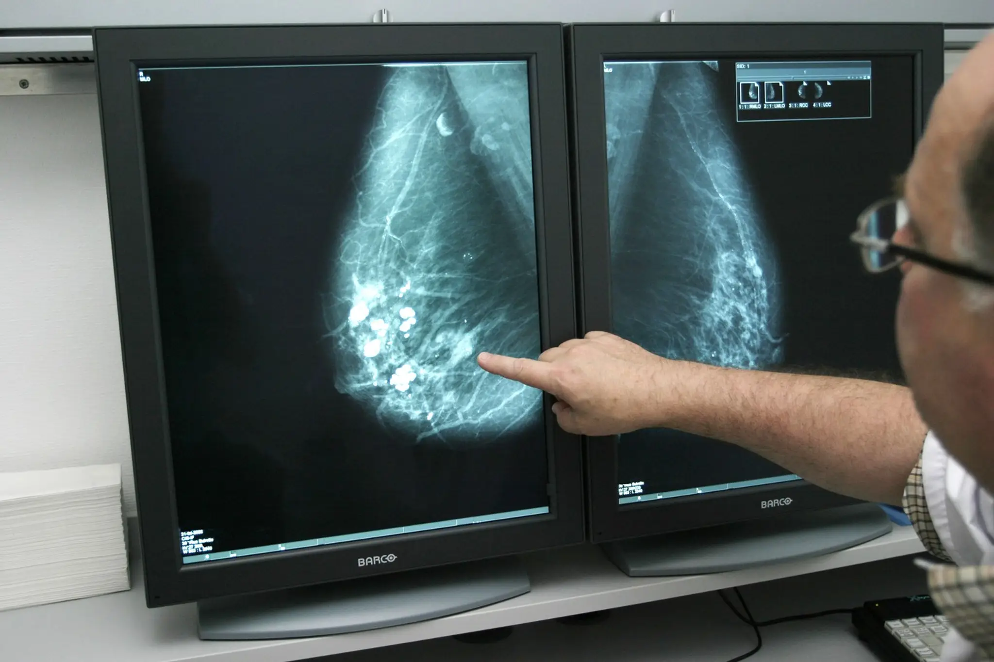 Ultrasonografia, snímok prsníka 
