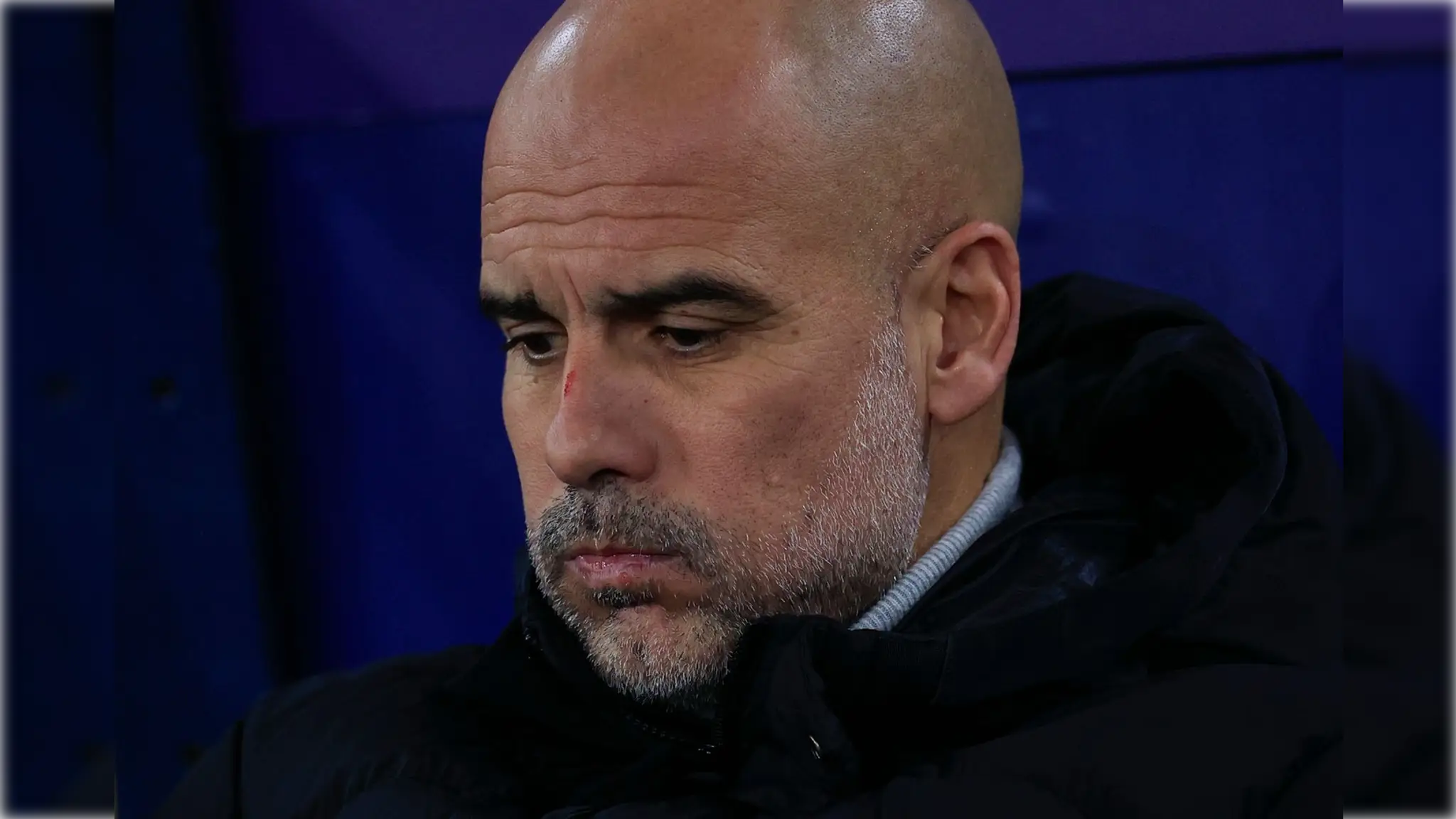 Pep Guardiola si spôsobil šrám na nose.