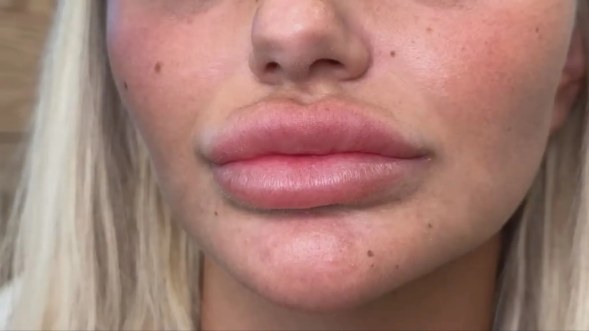 Kyselina hyalurónová môže spôsobovať komplikácie