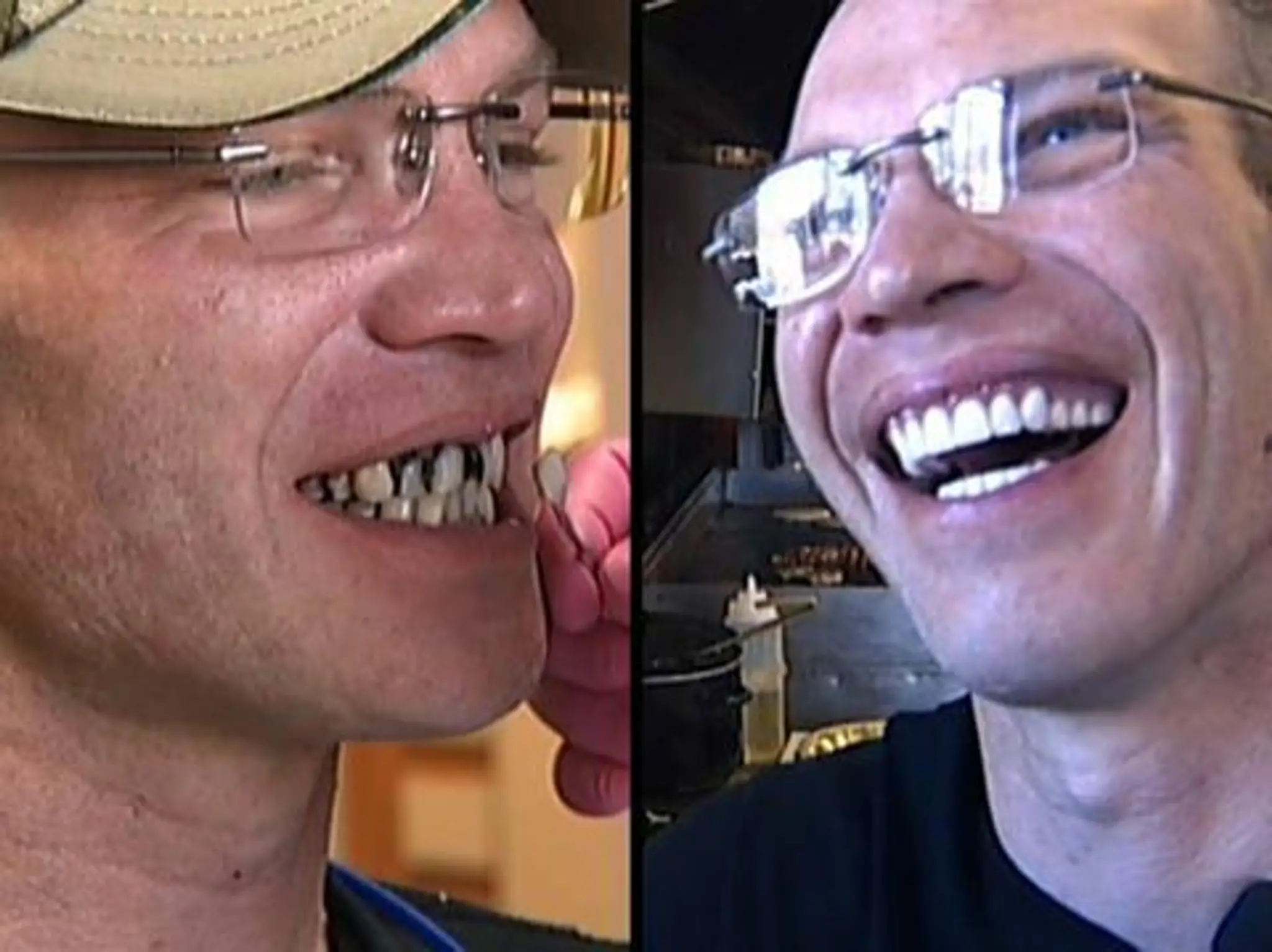 Brianov úsmev pred a po zákroku.