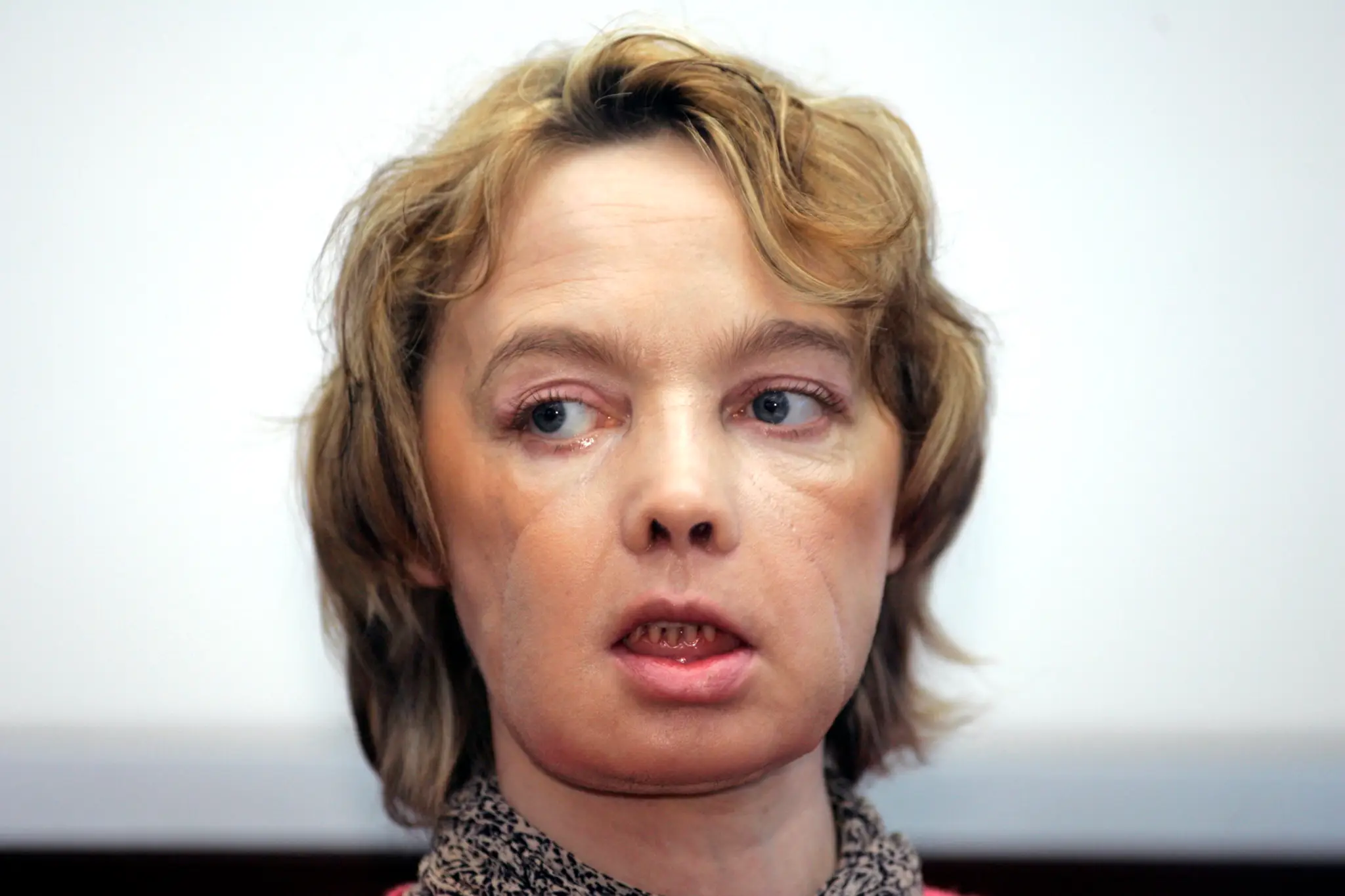 Isabelle Dinoire