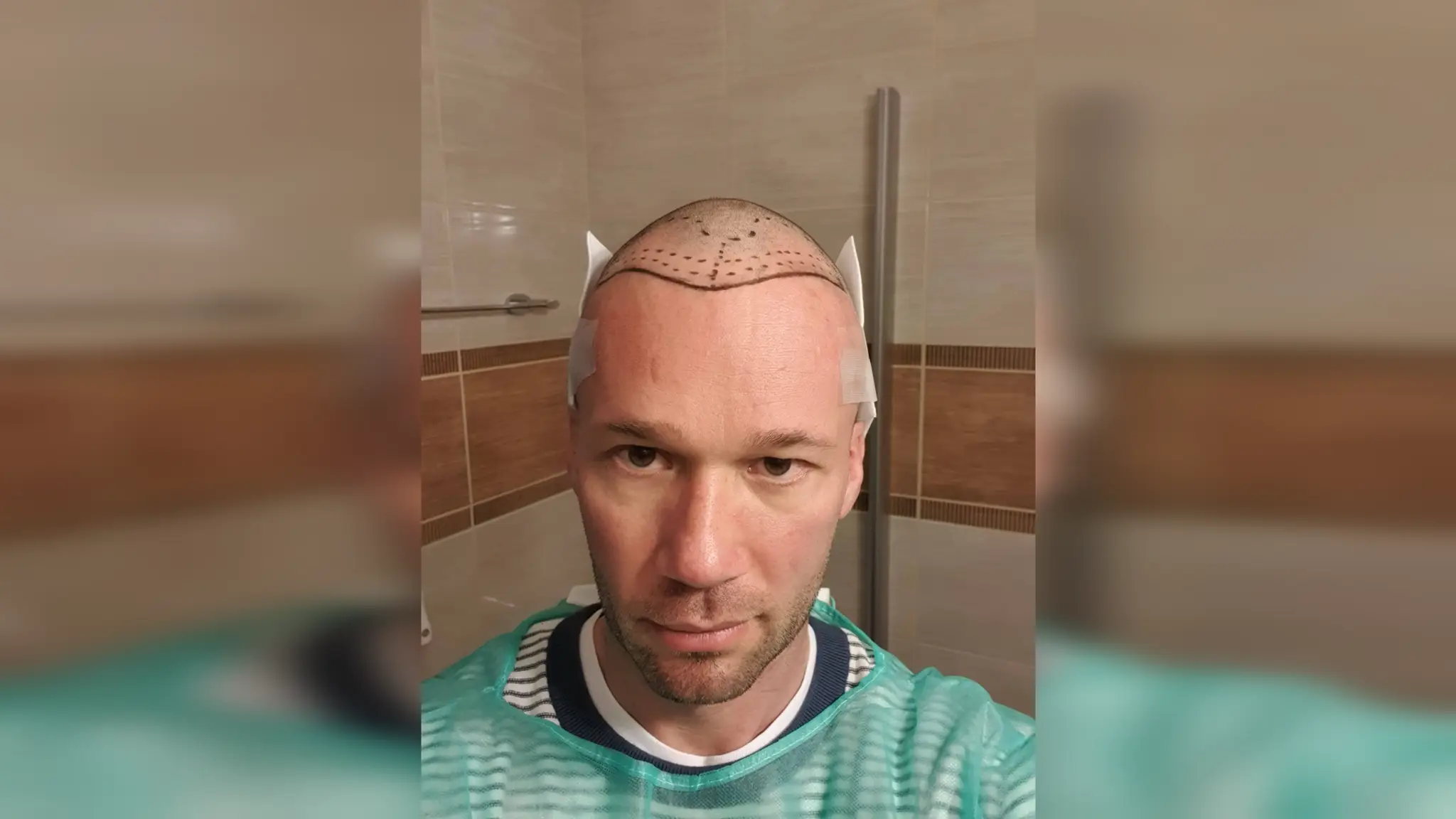 Tesne pred zákrokom.