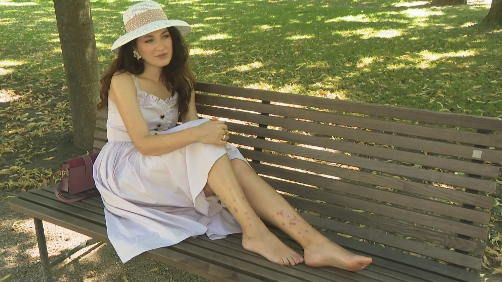 Denisa Vyšňovská už psoriázu neskrýva.