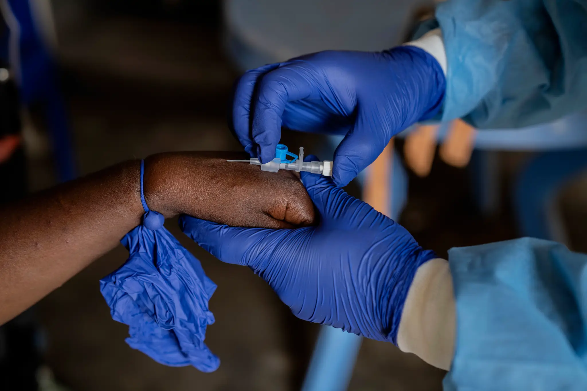 Zdravotník ošetruje pacienta nakazeného vírusovým ochorením mpox.