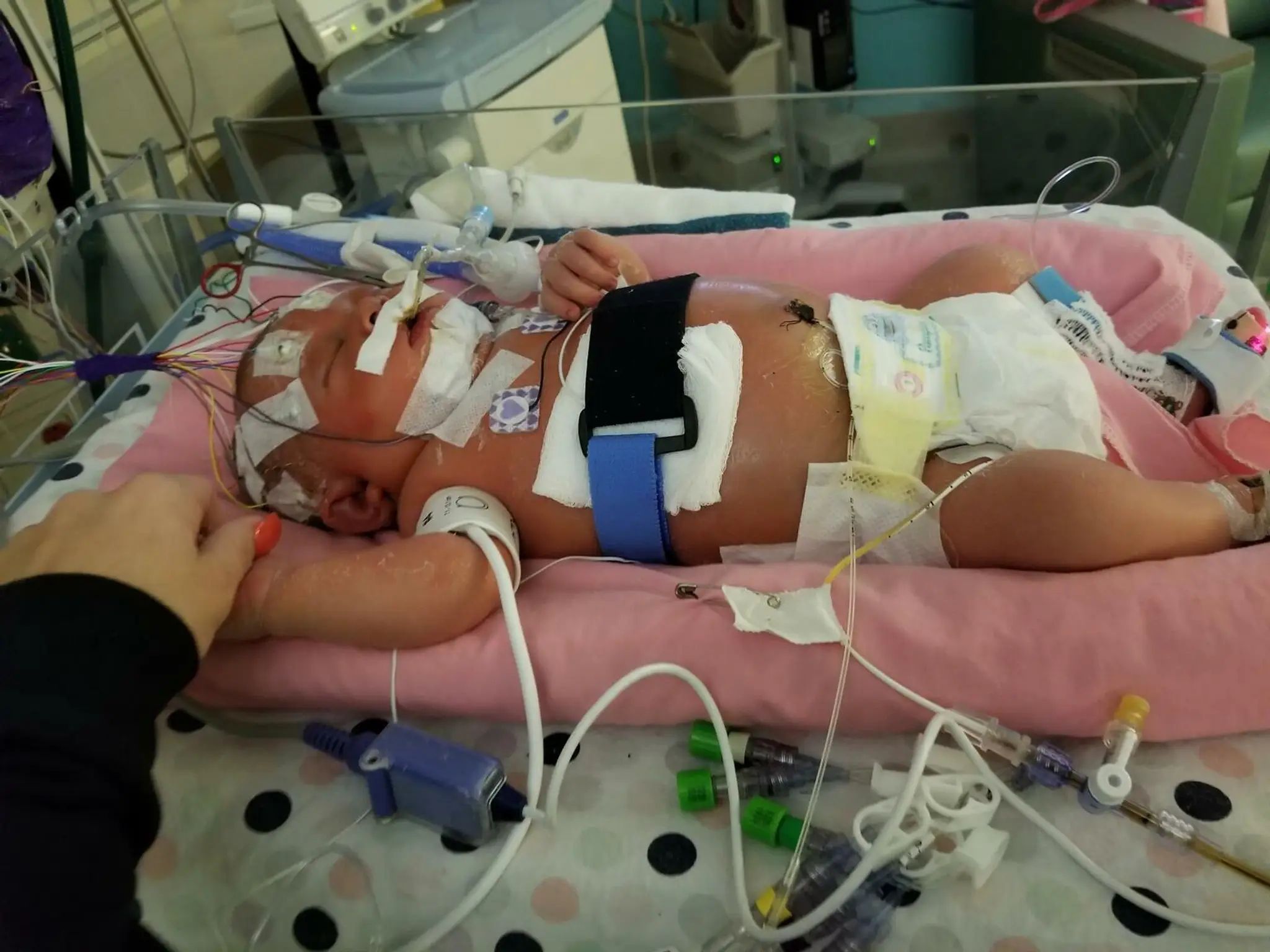Šesťdňové bábätko skončilo po bozku v nemocnici. Zatiaľ neúspešne bojuje o život