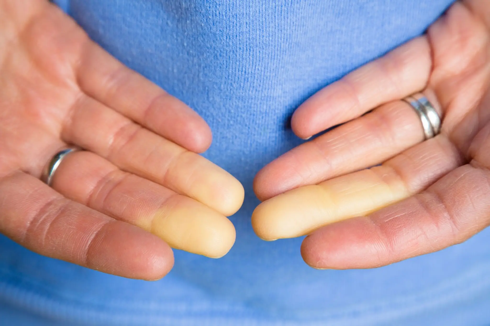 Raynaudovo ochorenie