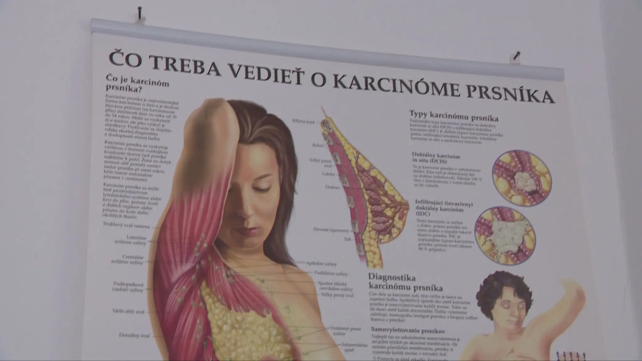 Karcinóm prsníka