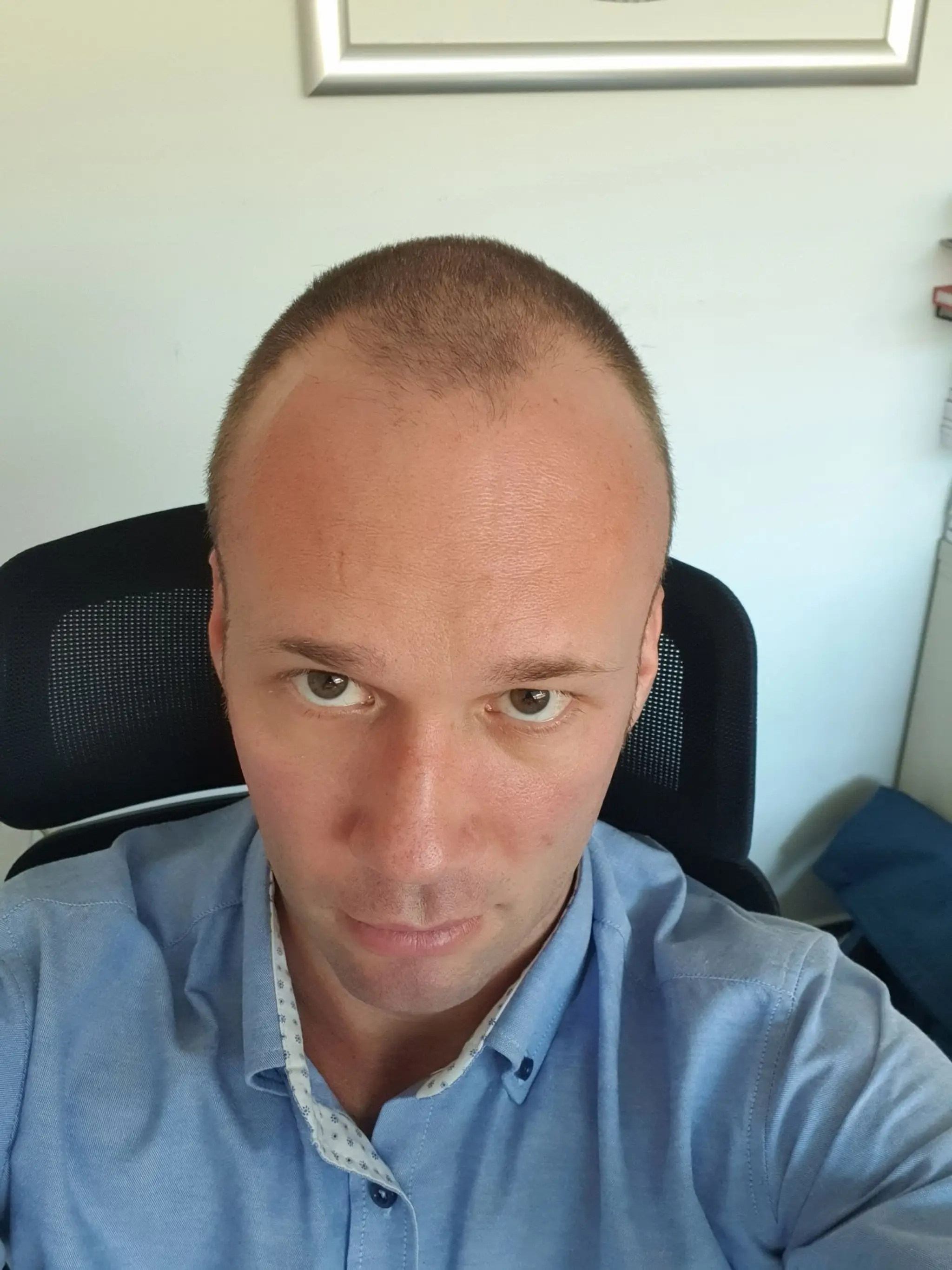 Roman pred zákrokom. Prekážali mu kúty.
