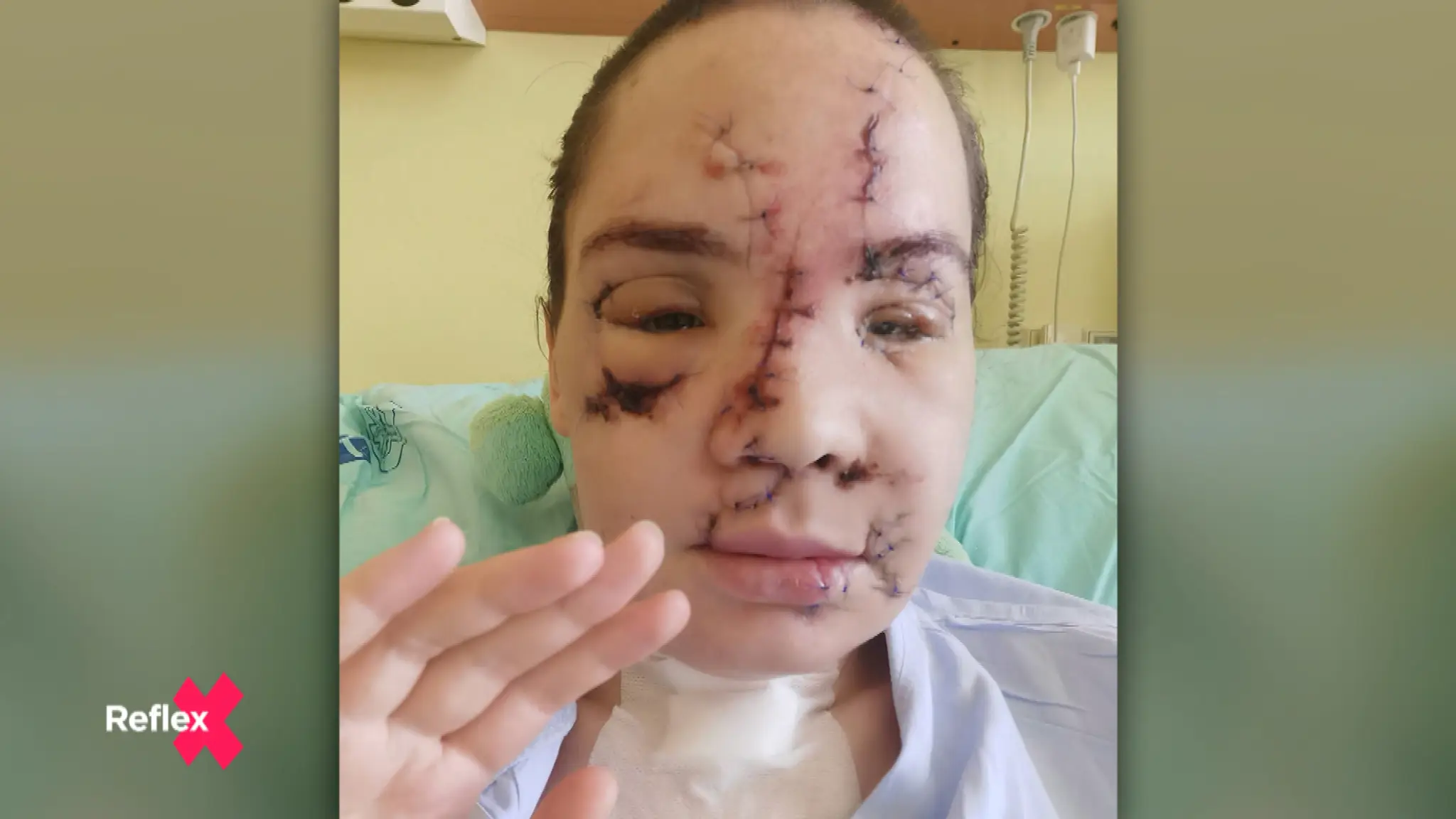 Prežila zrážku s vlakom. Nehoda úplne zmenila jej vzhľad