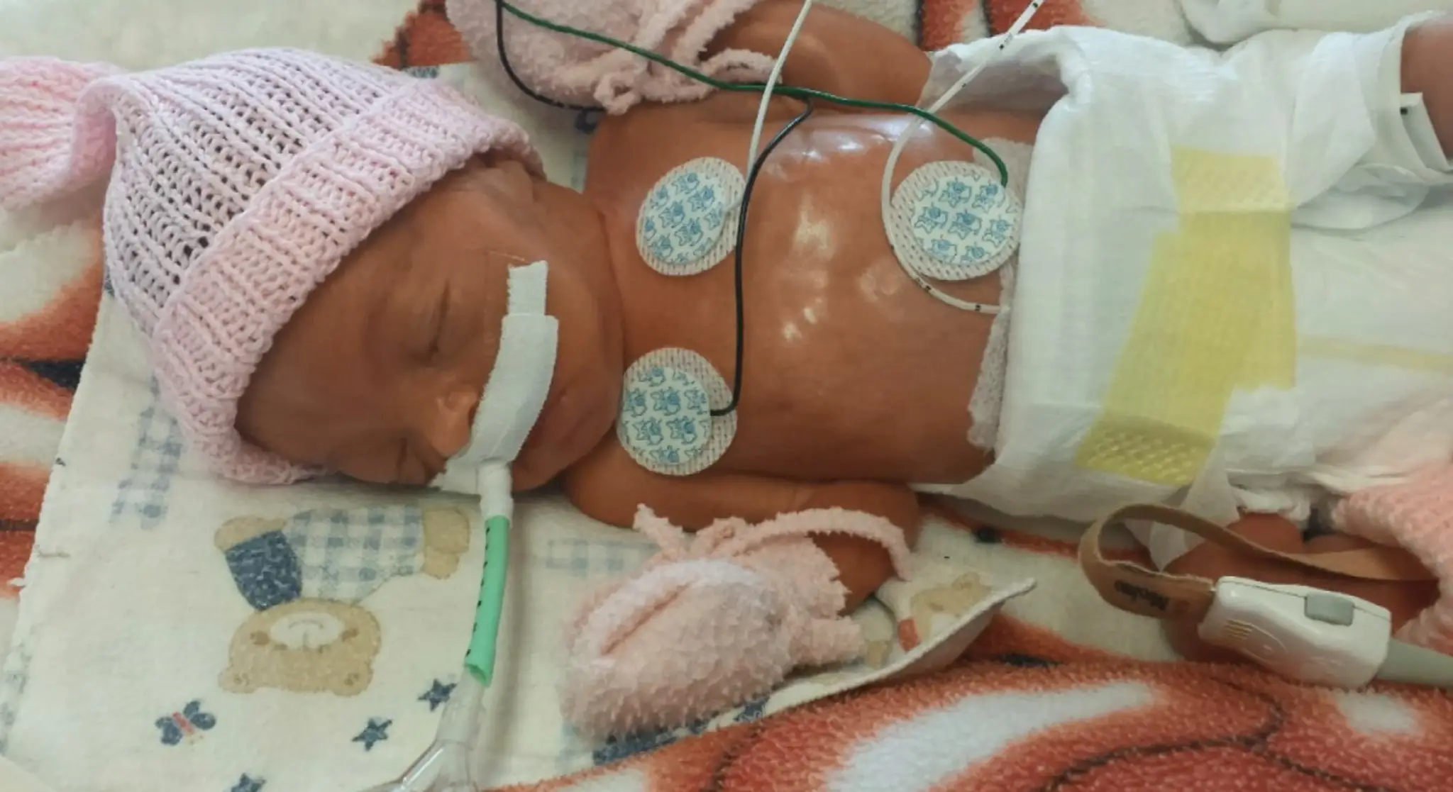 Predčasne narodená Alžbetka boj o život vyhrala. Stále však potrebuje pomoc