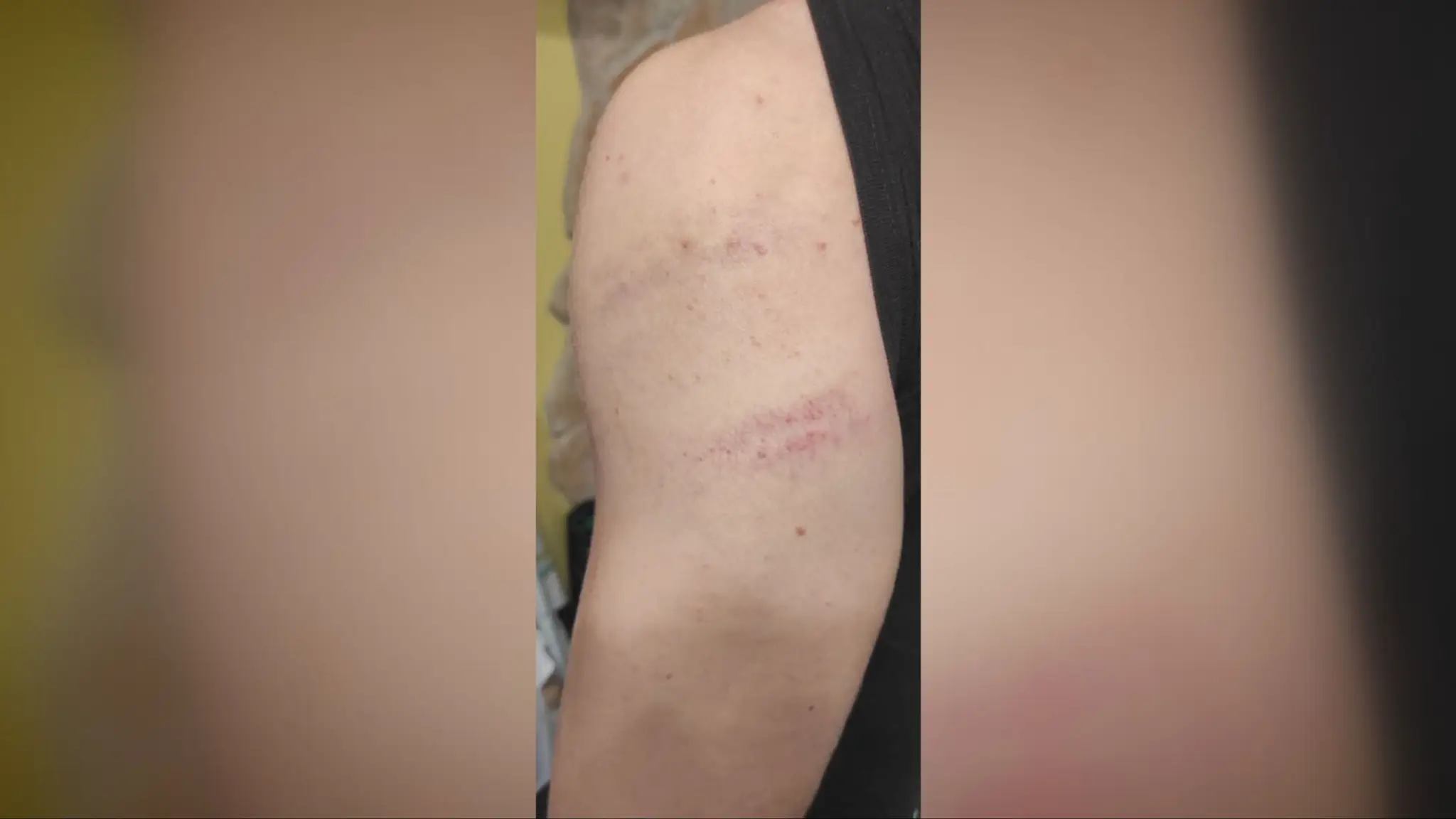 Chlapec prišiel z mikulášskej akcie s modrinami