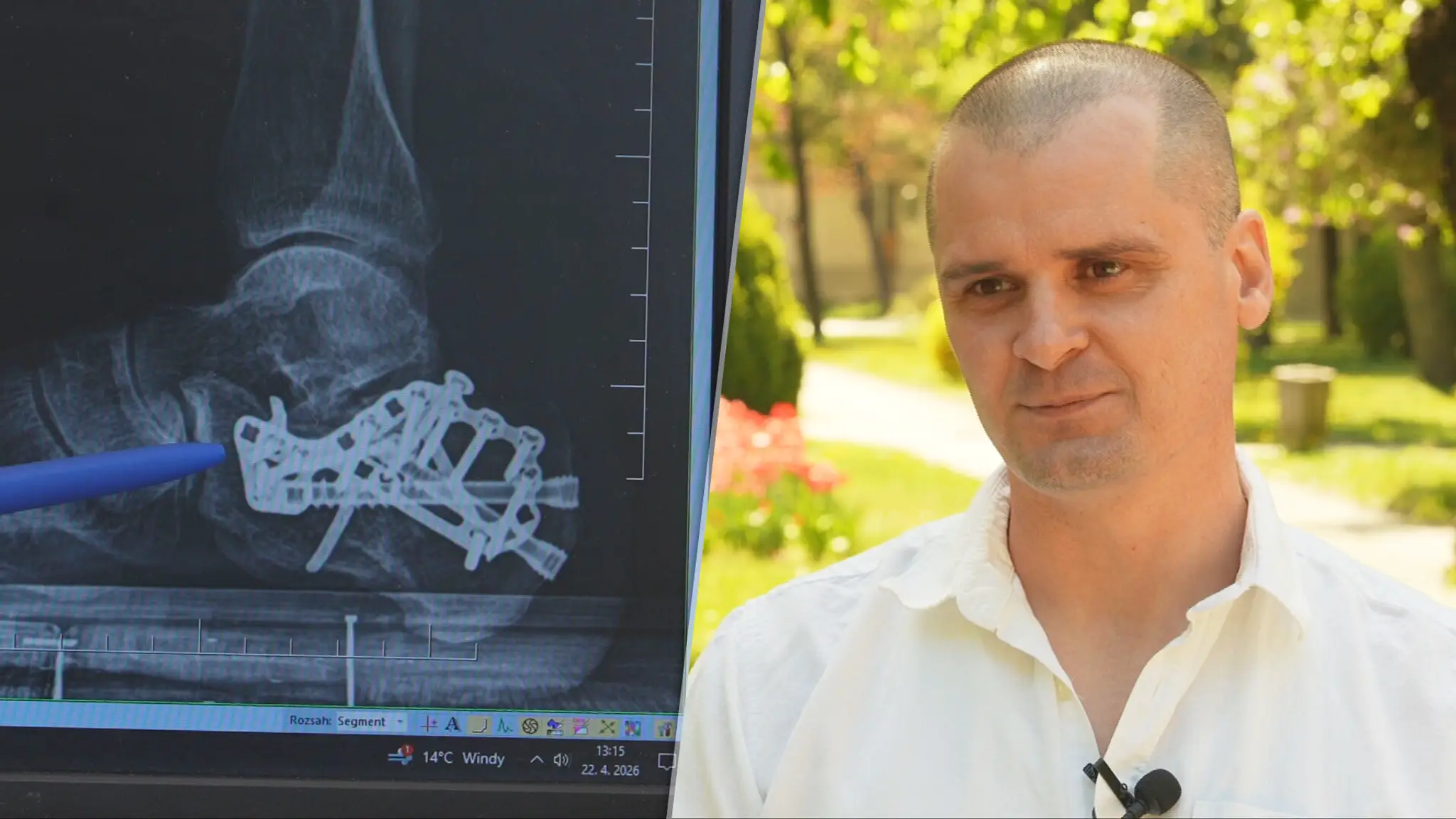 Muž utrpel trieštivú zlomeninu päty 