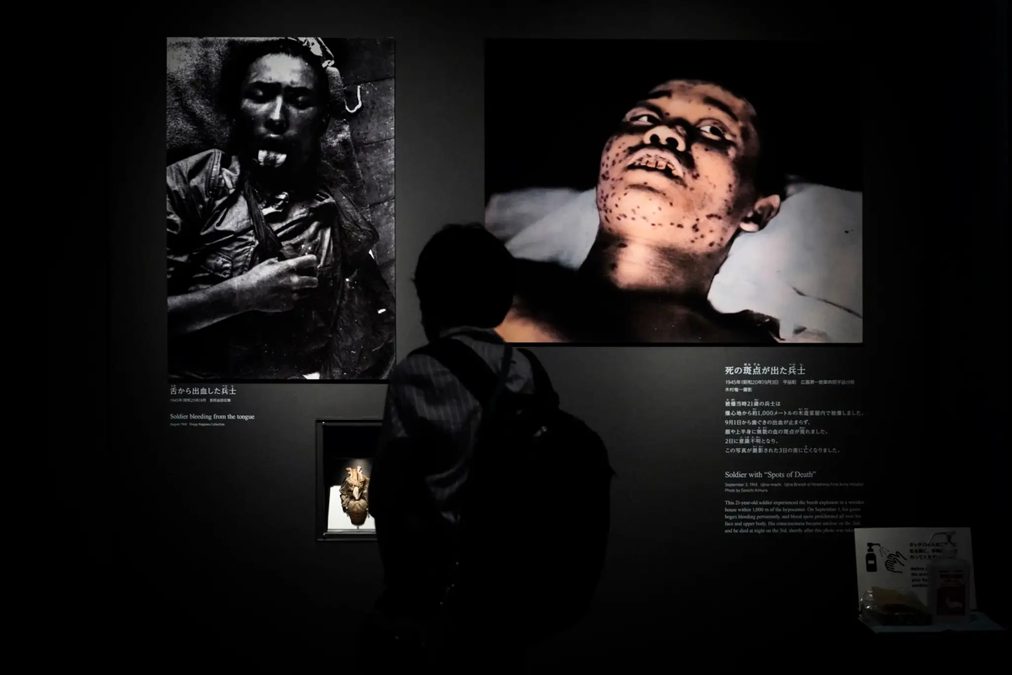 Fotografie zranených japonských vojakov v Múzeu mieru v Hirošime