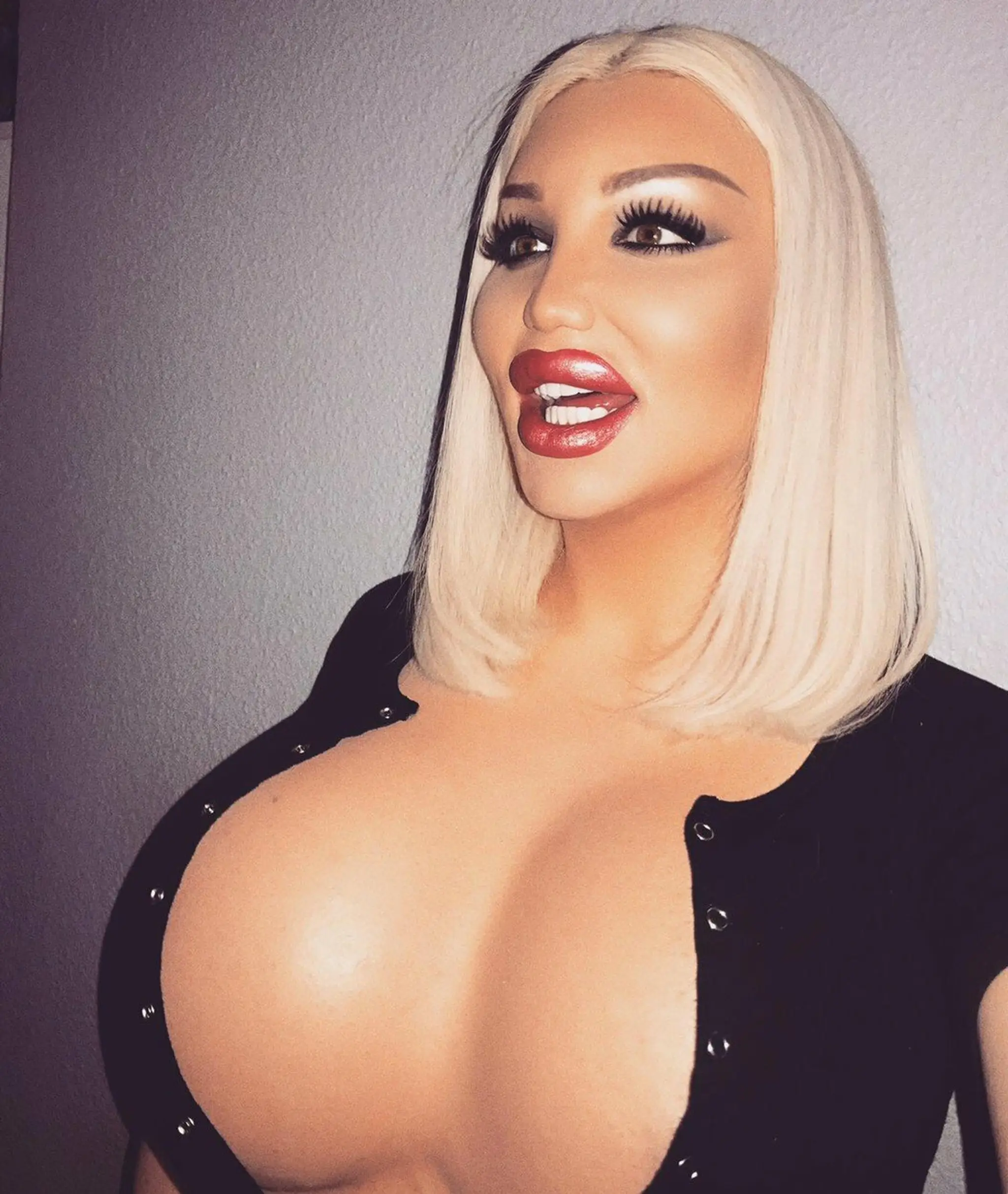 Ivana Vladislava po odstránení silikónu.