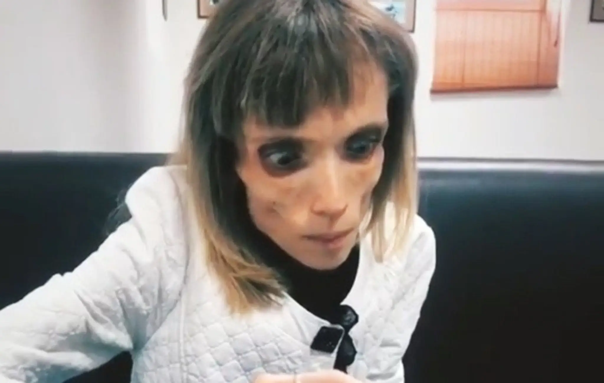 Kristina Karyagina trpí anorexiou