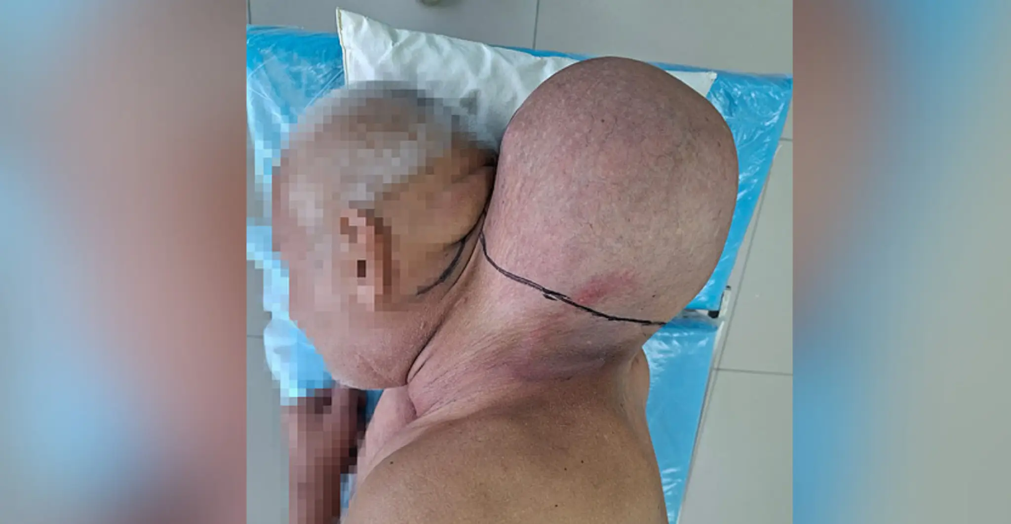 Mužovi z krku odstránili nádor veľký ako hlava