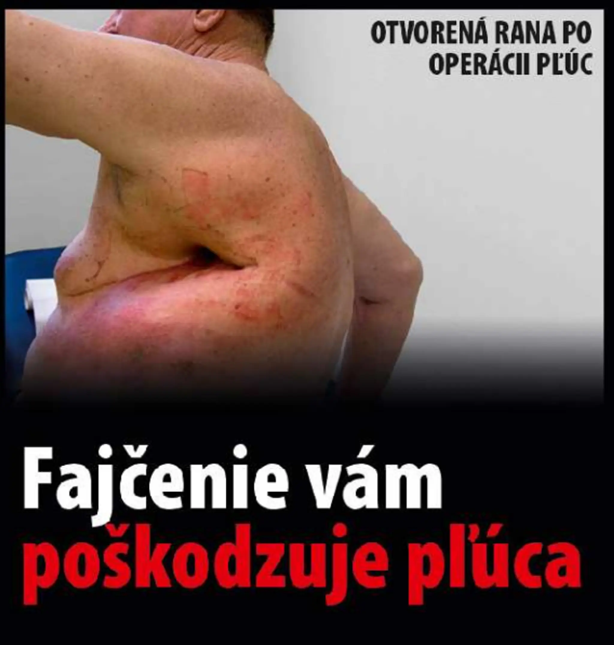 Varovanie, čo všetko môže spôsobiť fajčenie