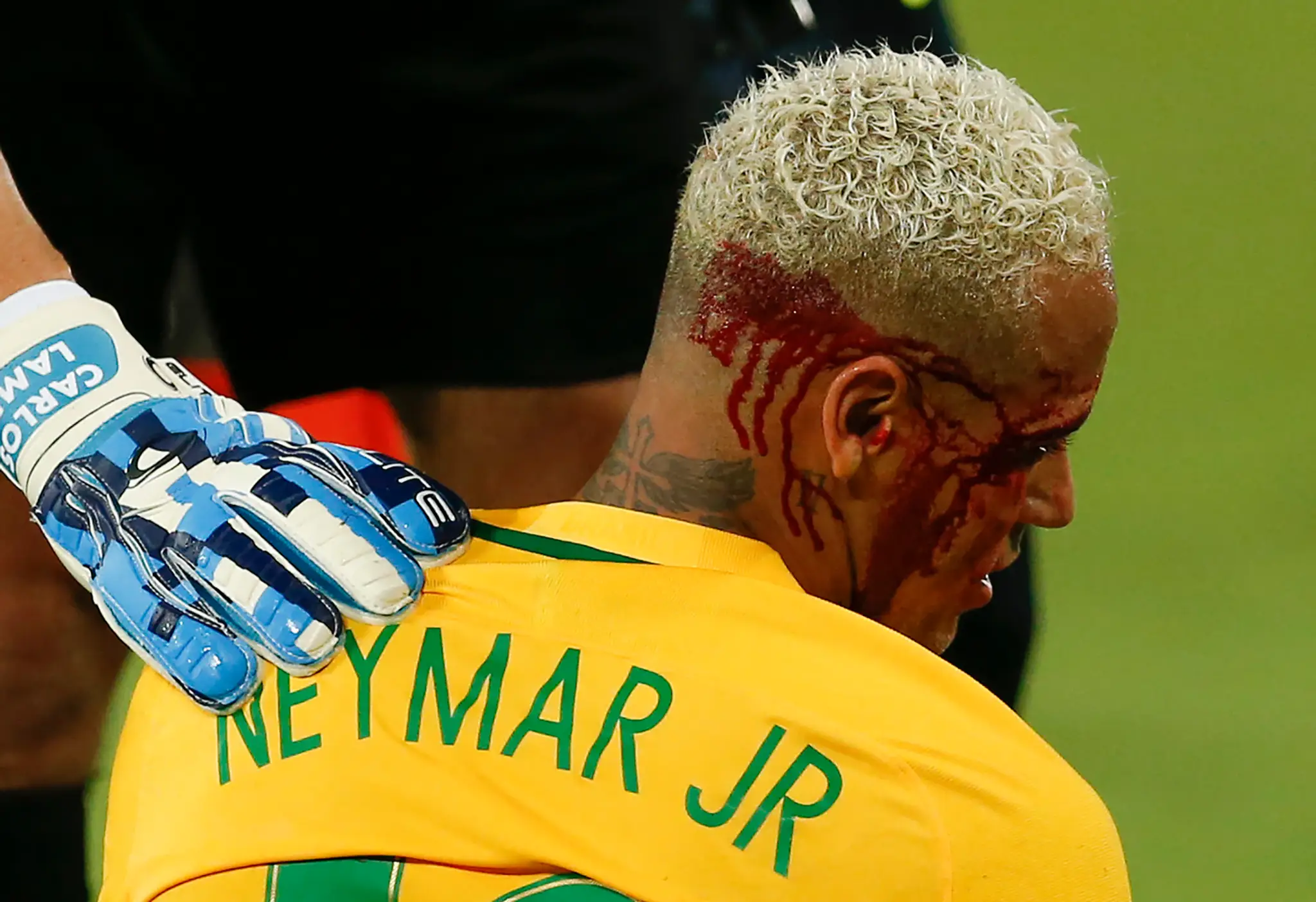 Zranený brazílsky hráč Neymar v 9. kole juhoamerickej kvalifikácie o postup na futbalové MS 2018 proti Bolívii.
