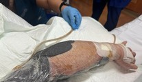 Mäsožravá infekcia mu takmer vzala život. V jednu chvíľu mi bolo vidieť skrz ruku, popísal
