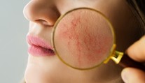 Trápi vás začervenaná tvár či karfiolový nos? Dermatologička radí, ako ich liečiť