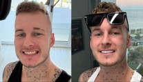 Rovný a biely úsmev. Rozprávali sme sa so Slovákom, ktorý si dal spraviť v Turecku zuby