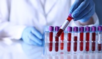 Jednoduchý krvný test môže odhaliť vážnu chorobu ešte skôr, než začnete zabúdať