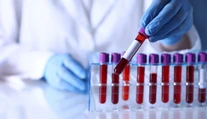 Jednoduchý krvný test môže odhaliť vážnu chorobu ešte skôr, než začnete zabúdať