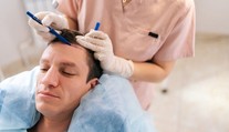 Nové vlasy nový život: Ako prebieha moderná transplantácia vlasov?