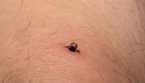 Zostal vám po vybratí kúsok kliešťa v koži? Lekárka radí, čo s ním určite nerobiť