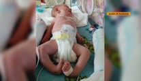Narodil sa s konskou nožičkou. Má za sebou náročnú operáciu, potrebuje aj ďalšiu