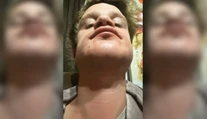 Žena chcela priateľovi natrieť bradu farbou na vlasy. Bizarný nápad skončil popáleninami