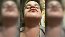 Žena chcela priateľovi natrieť bradu farbou na vlasy. Bizarný nápad skončil popáleninami