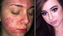 Tínedžerka trpela hrozným akné. Takto ho dokázala maskovať
