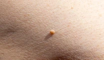 Malé kožné výrastky vyzerajú nevinne. Dermatologička varuje pred ich domácim odstraňovaním