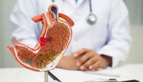 Rakovina žalúdka sa spočiatku prejavuje nenápadne. Najčastejšie príznaky, ktoré ľudia ignorujú