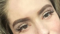 Česká YouTuberka, ktorá utrpela hrozivé popáleniny: Prvýkrát ukázala tvár